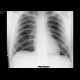 Pneumothorax, small: X-ray - Plain radiograph